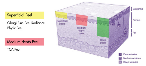 Chemical Skin Peels Diagram